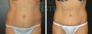 Tummy Tuck Patient