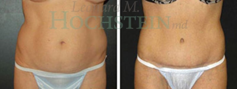Tummy Tuck Patient