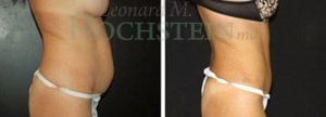 Tummy Tuck Patient