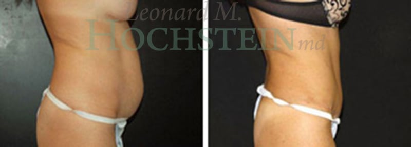 Tummy Tuck Patient