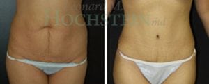 Tummy Tuck Patient