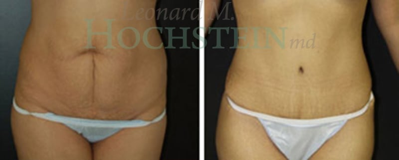 Tummy Tuck Patient