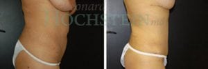 Tummy Tuck Patient