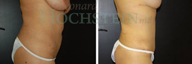 Tummy Tuck Patient