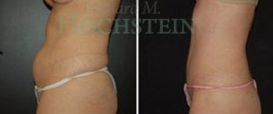 Tummy Tuck Patient