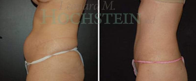 Tummy Tuck Patient