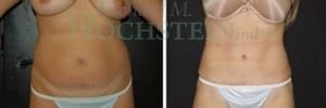 Tummy Tuck Patient