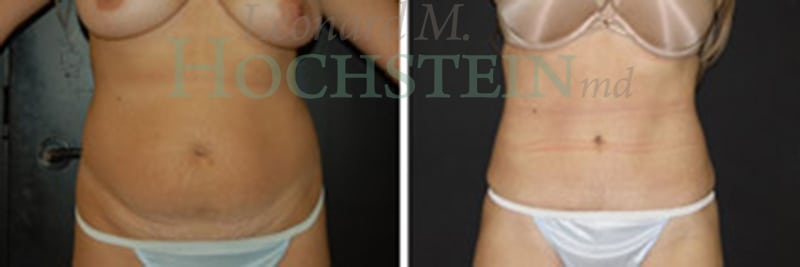 Tummy Tuck Patient