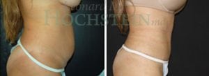 Tummy Tuck Patient