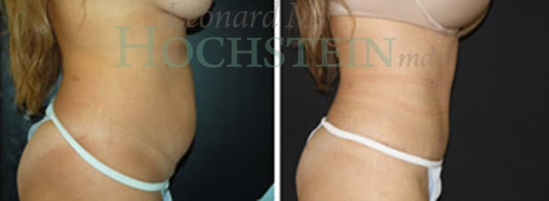 Tummy Tuck Patient