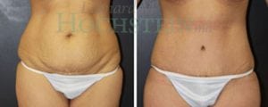 Tummy Tuck Patient
