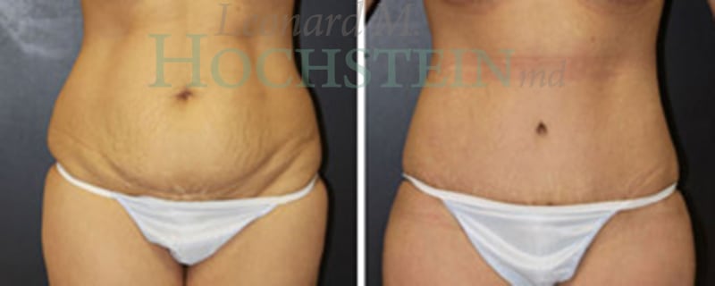 Tummy Tuck Patient