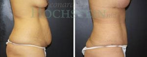 Tummy Tuck Patient