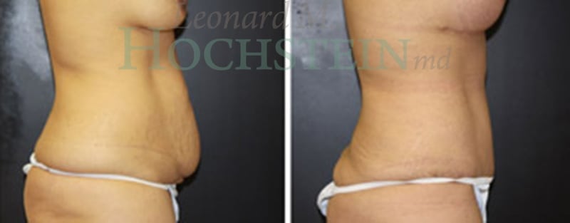 Tummy Tuck Patient