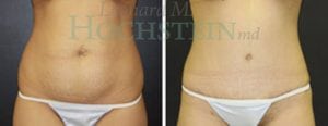Tummy Tuck Patient