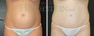 Tummy Tuck Patient