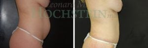 Tummy Tuck Patient