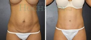 Tummy Tuck Patient