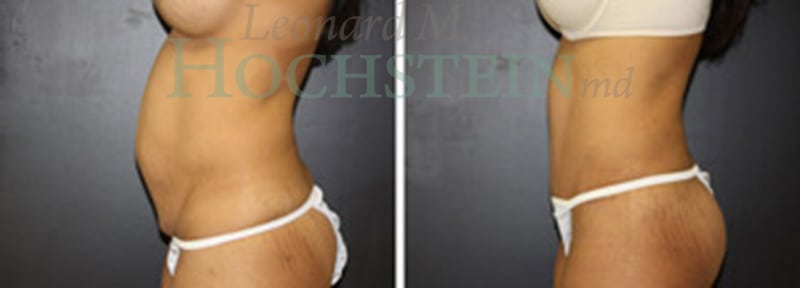 Tummy Tuck Patient