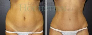 Tummy Tuck Patient