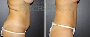 Tummy Tuck Patient