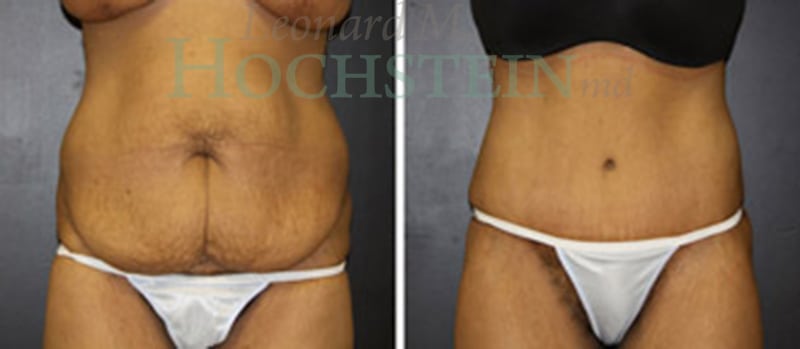 Tummy Tuck Patient