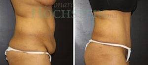 Tummy Tuck Patient