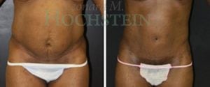 Tummy Tuck Patient