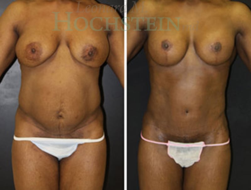 Tummy Tuck Patient
