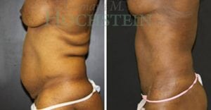 Tummy Tuck Patient