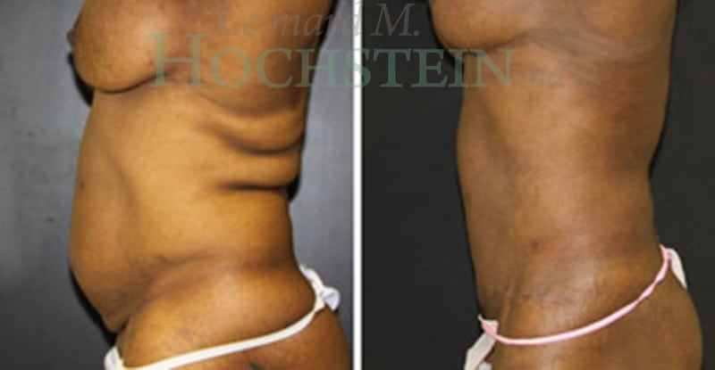 Tummy Tuck Patient