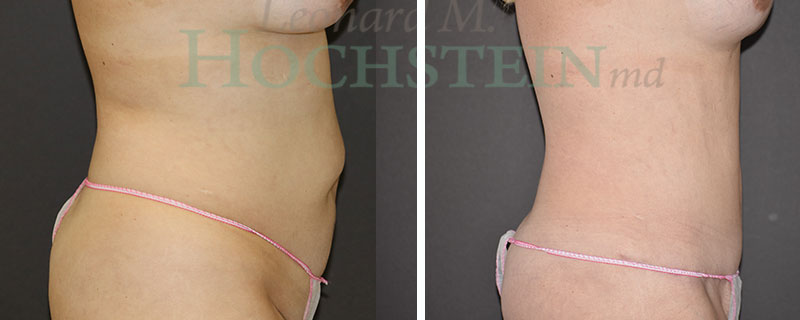 Tummy Tuck Patient