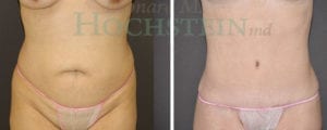 Tummy Tuck Patient