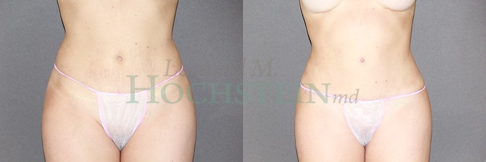 Tummy Tuck Patient