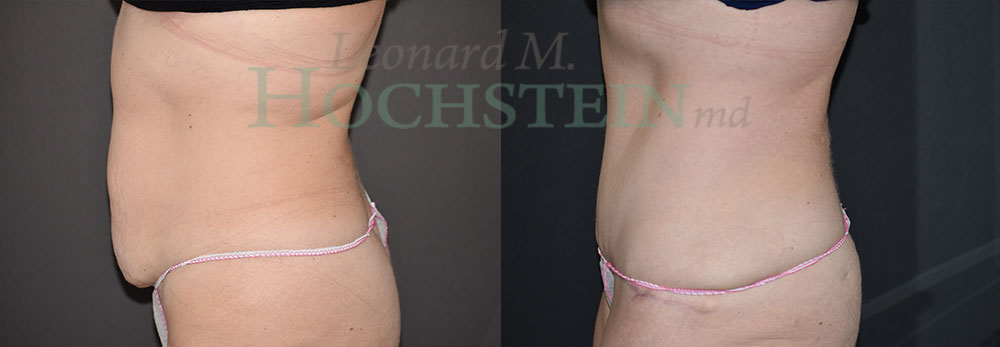 Tummy Tuck Patient