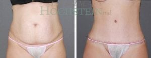 Tummy Tuck Patient