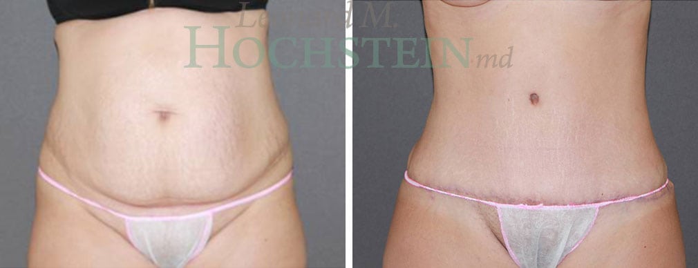 Tummy Tuck Patient