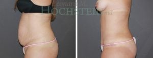 Tummy Tuck Patient