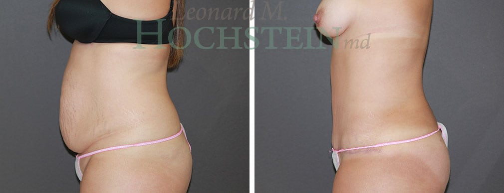 Tummy Tuck Patient