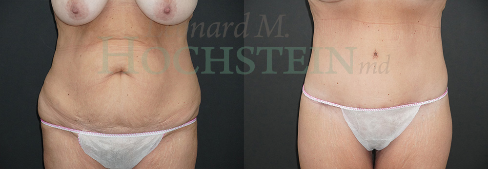 Tummy Tuck Patient