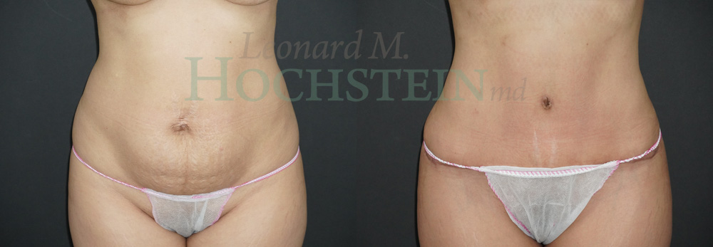 Tummy Tuck Patient