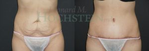 Tummy Tuck Patient 102
