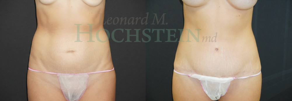 Tummy Tuck Patient