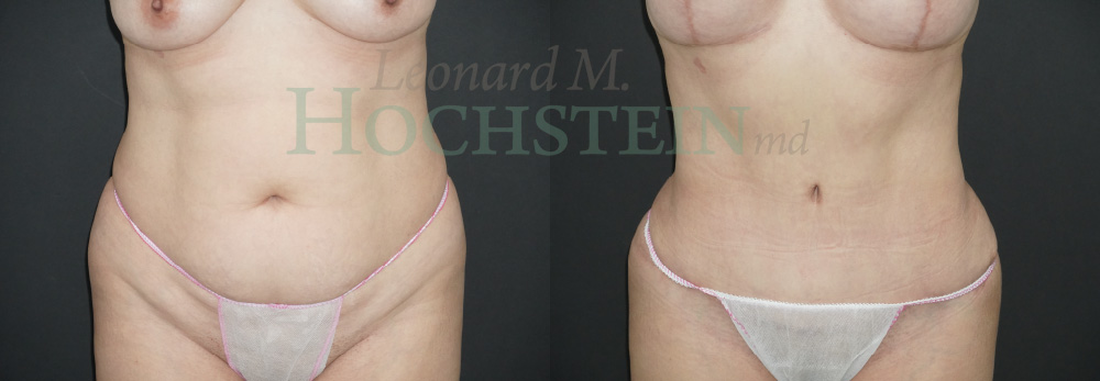 Tummy Tuck Patient