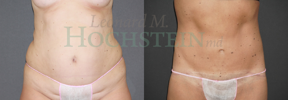 Tummy Tuck Patient