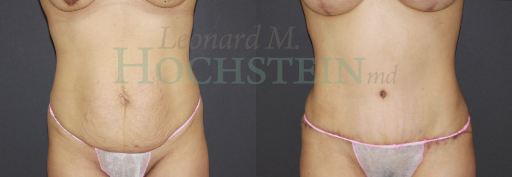 Tummy Tuck Patient