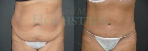Tummy Tuck Patient 108