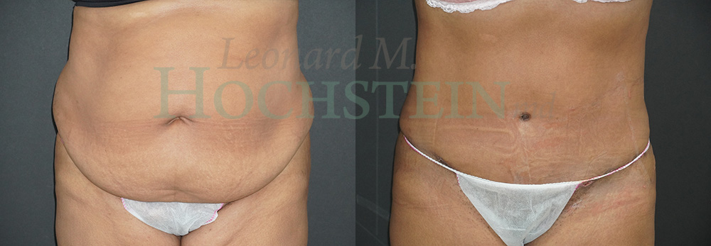 Tummy Tuck Patient