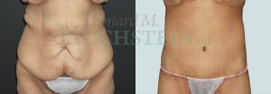 Tummy Tuck Patient 109