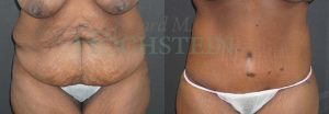 Tummy Tuck Patient 110